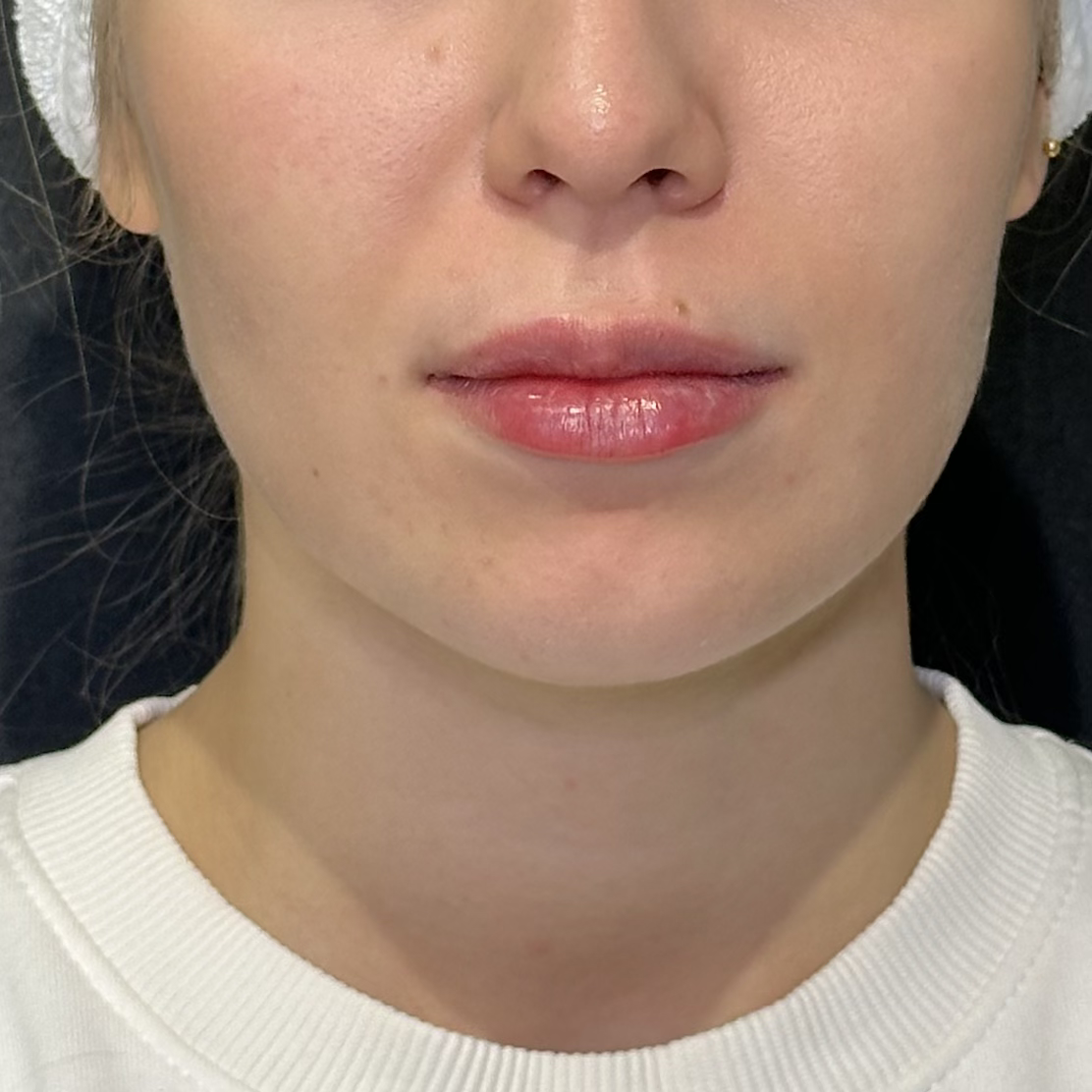 После процедуры Биоревитализация губ