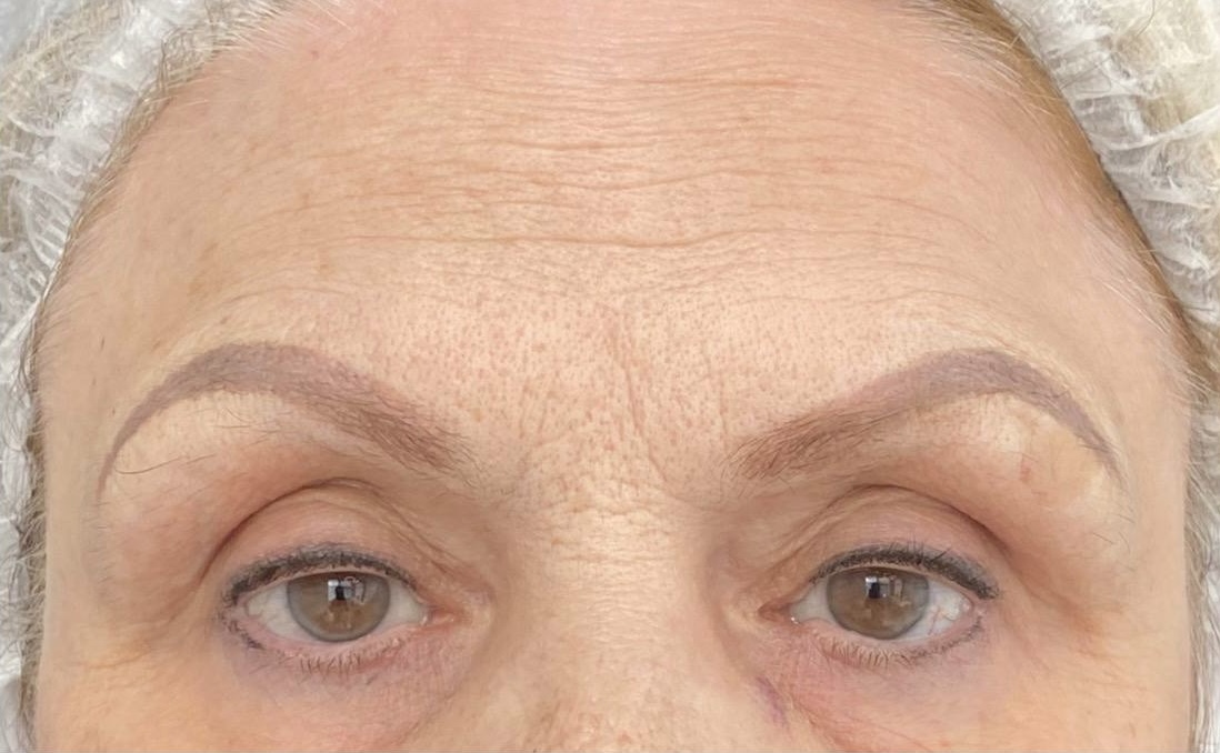 После процедуры Ботулинотерапия