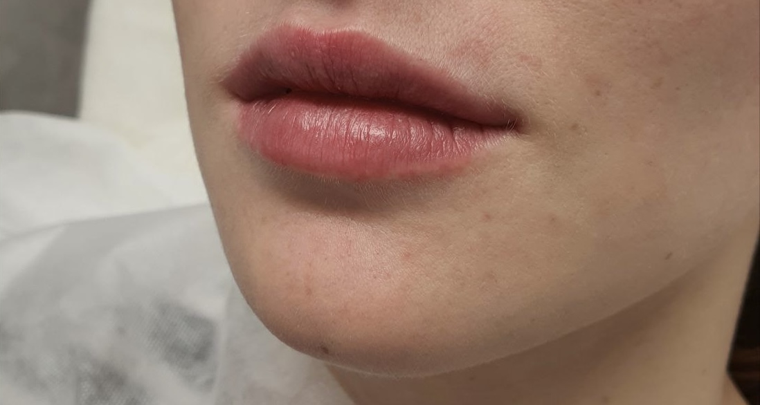 После процедуры Контурная пластика губ