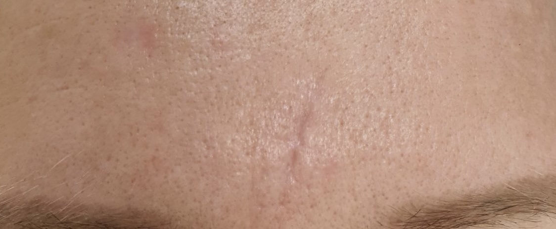 После процедуры Удаление рубца и доброкачественного новообразования