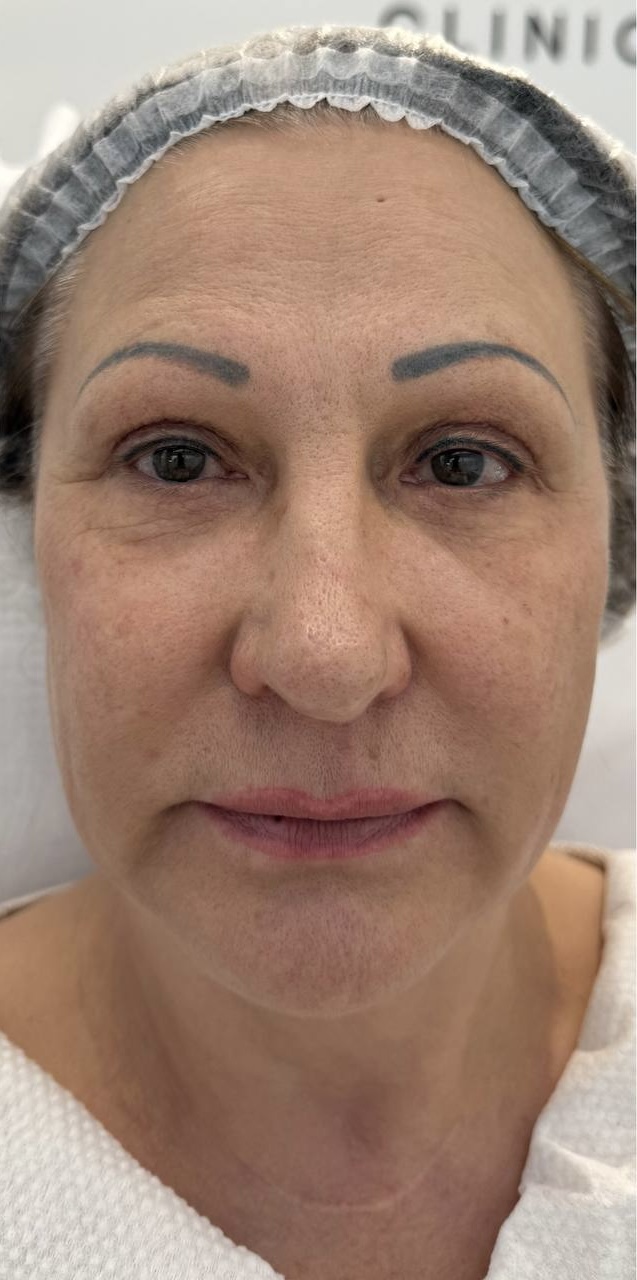 После процедуры Термолифтинг RF - Oligio