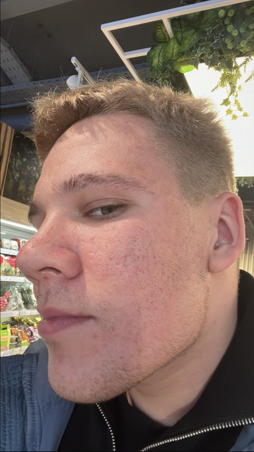 После процедуры Лазерная шлифовка кожи