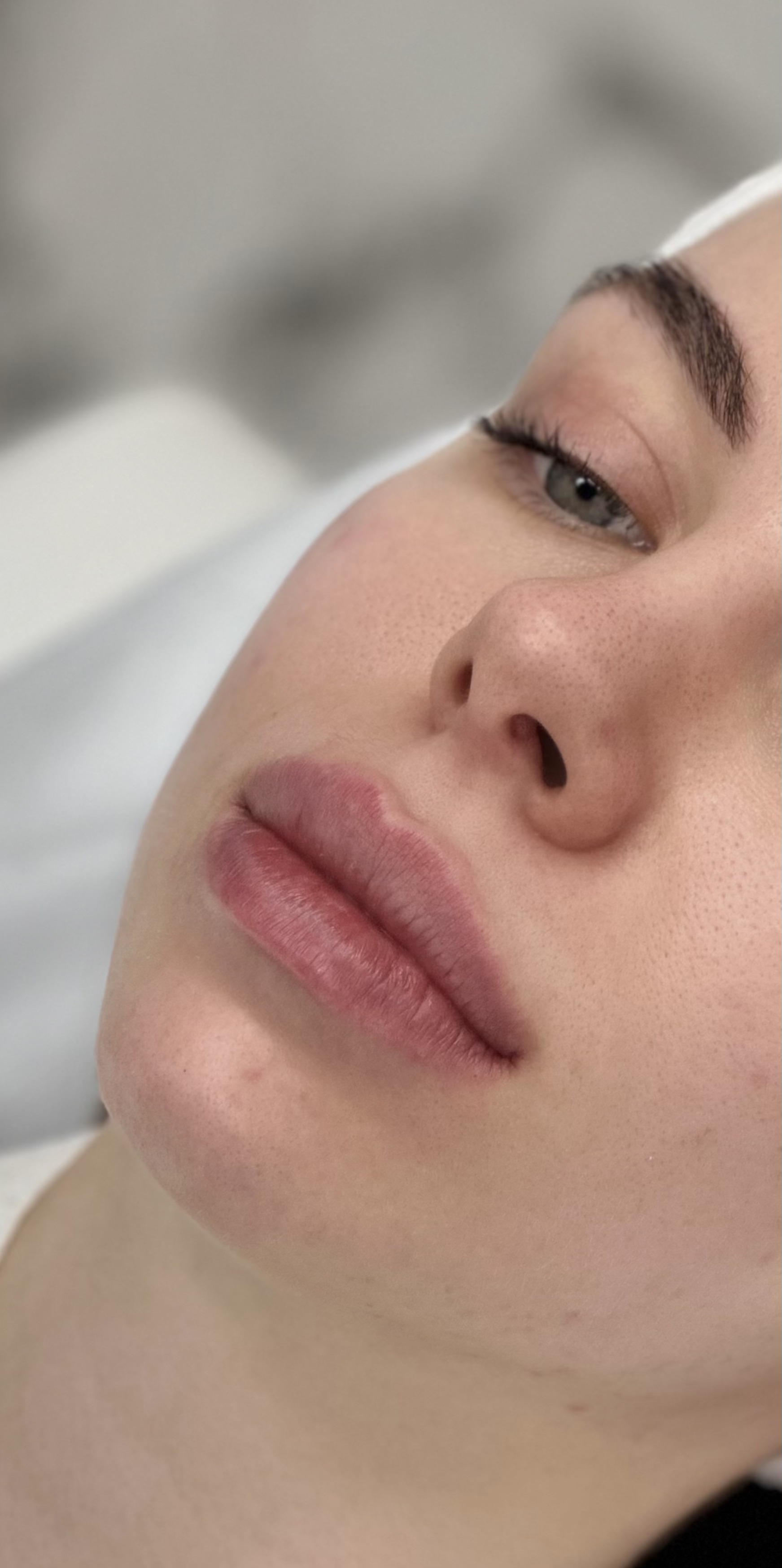 После процедуры Контурная пластика губ