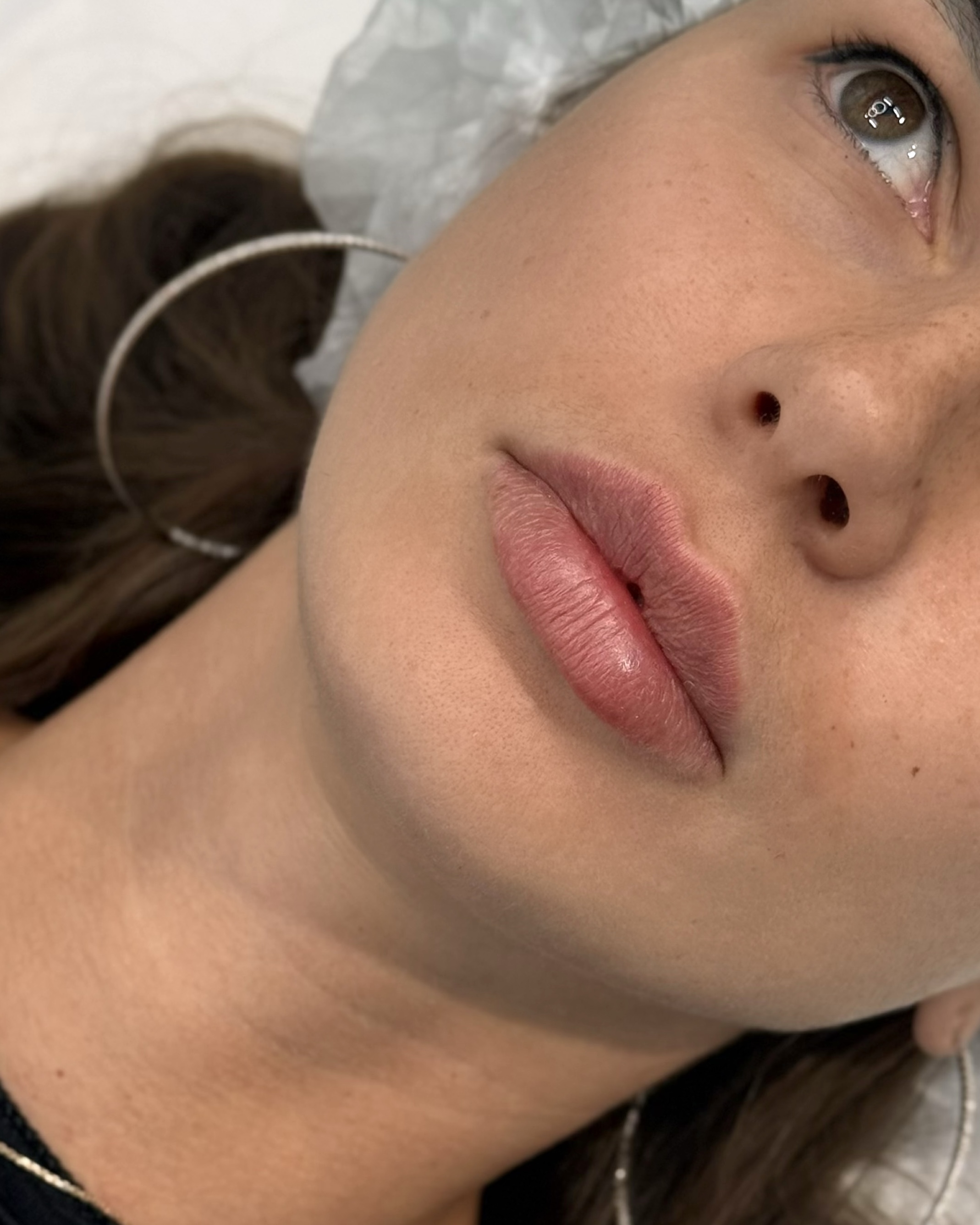 После процедуры Контурная пластика губ