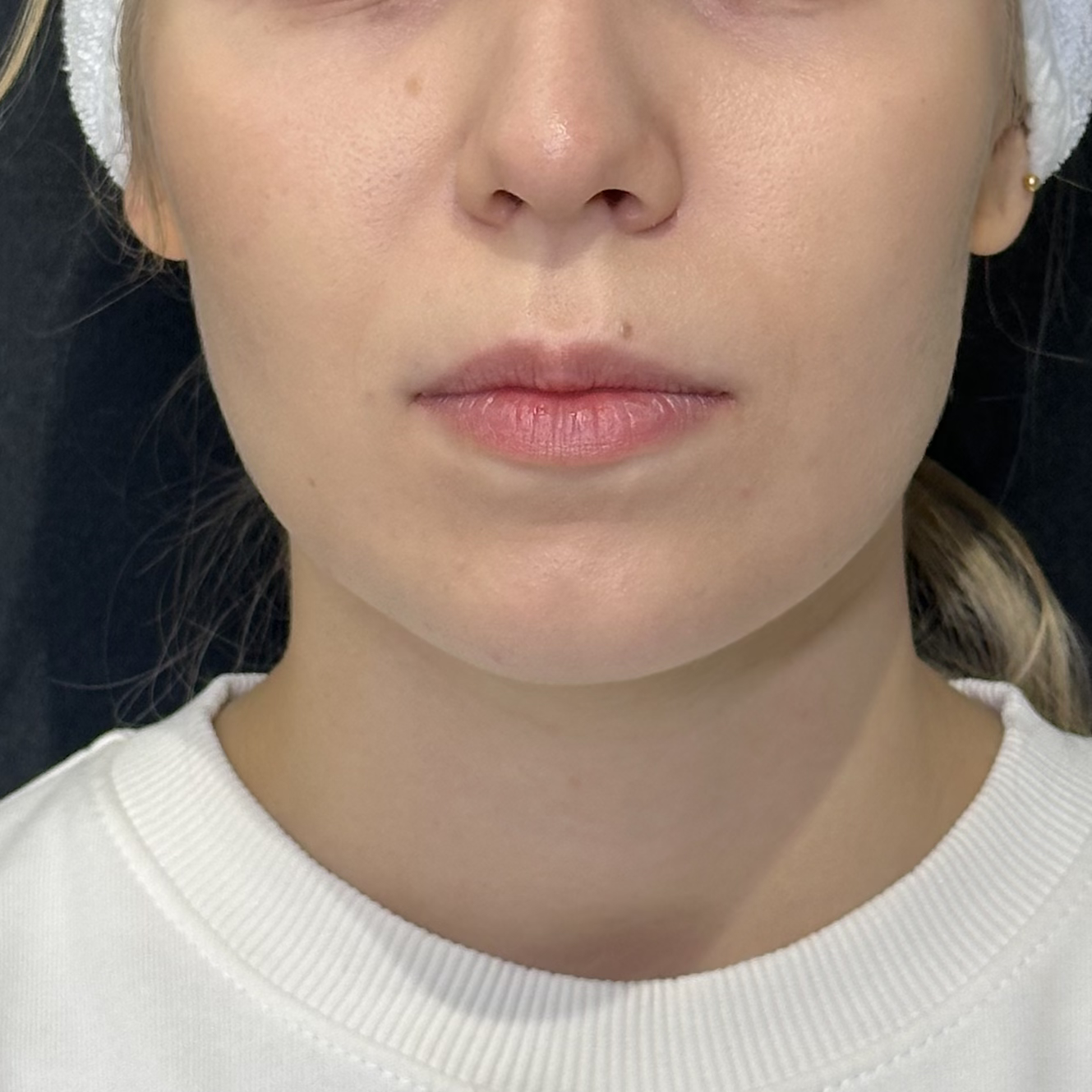 До процедуры Биоревитализация губ