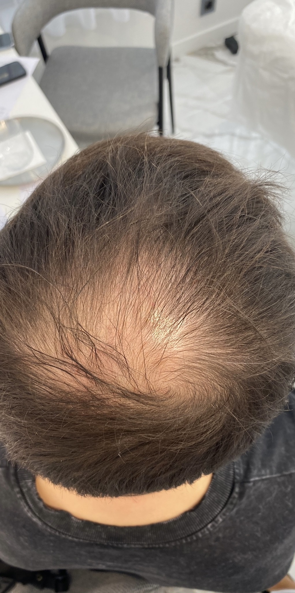 До процедуры Лечение алопеции