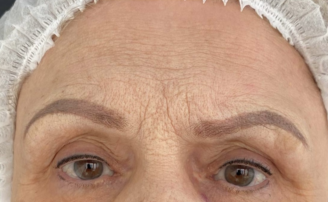 До процедуры Ботулинотерапия