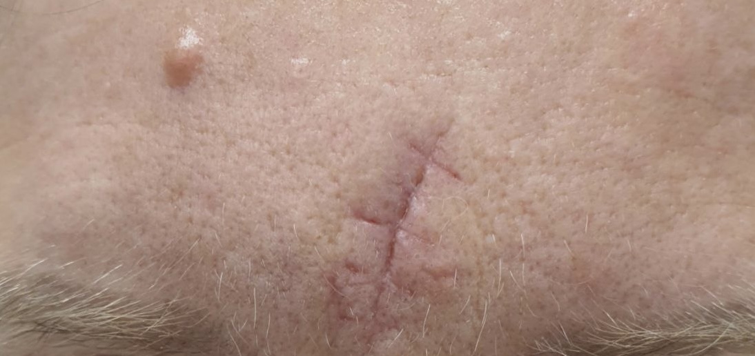 До процедуры Удаление рубца и доброкачественного новообразования