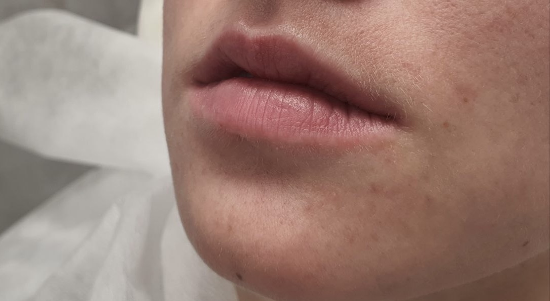 До процедуры Контурная пластика губ