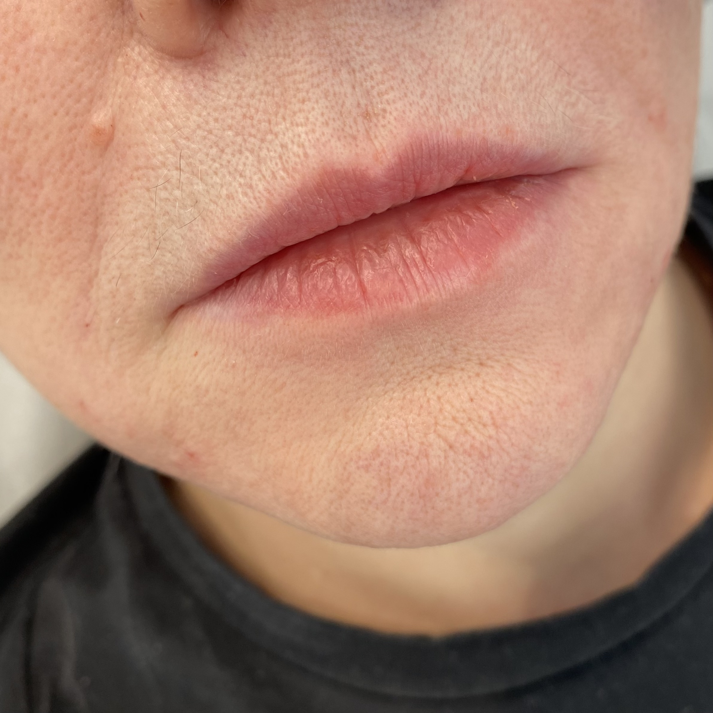 До процедуры Контурная пластика губ