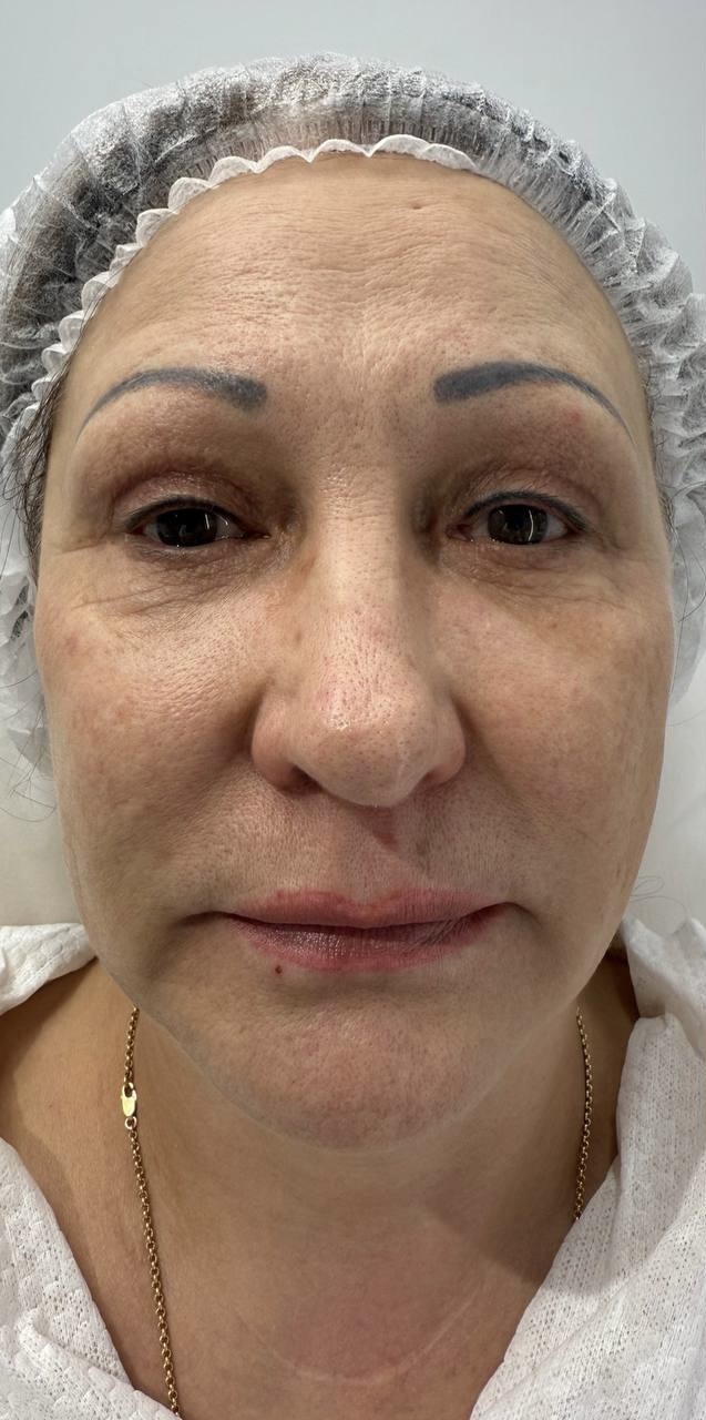 До процедуры Термолифтинг RF - Oligio