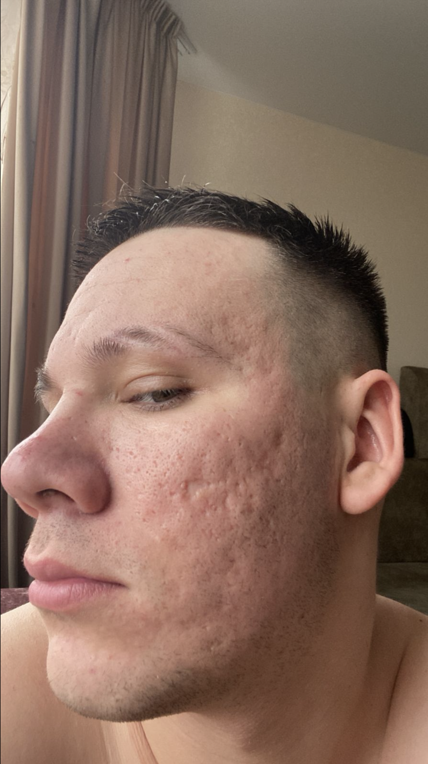 До процедуры Лазерная шлифовка кожи