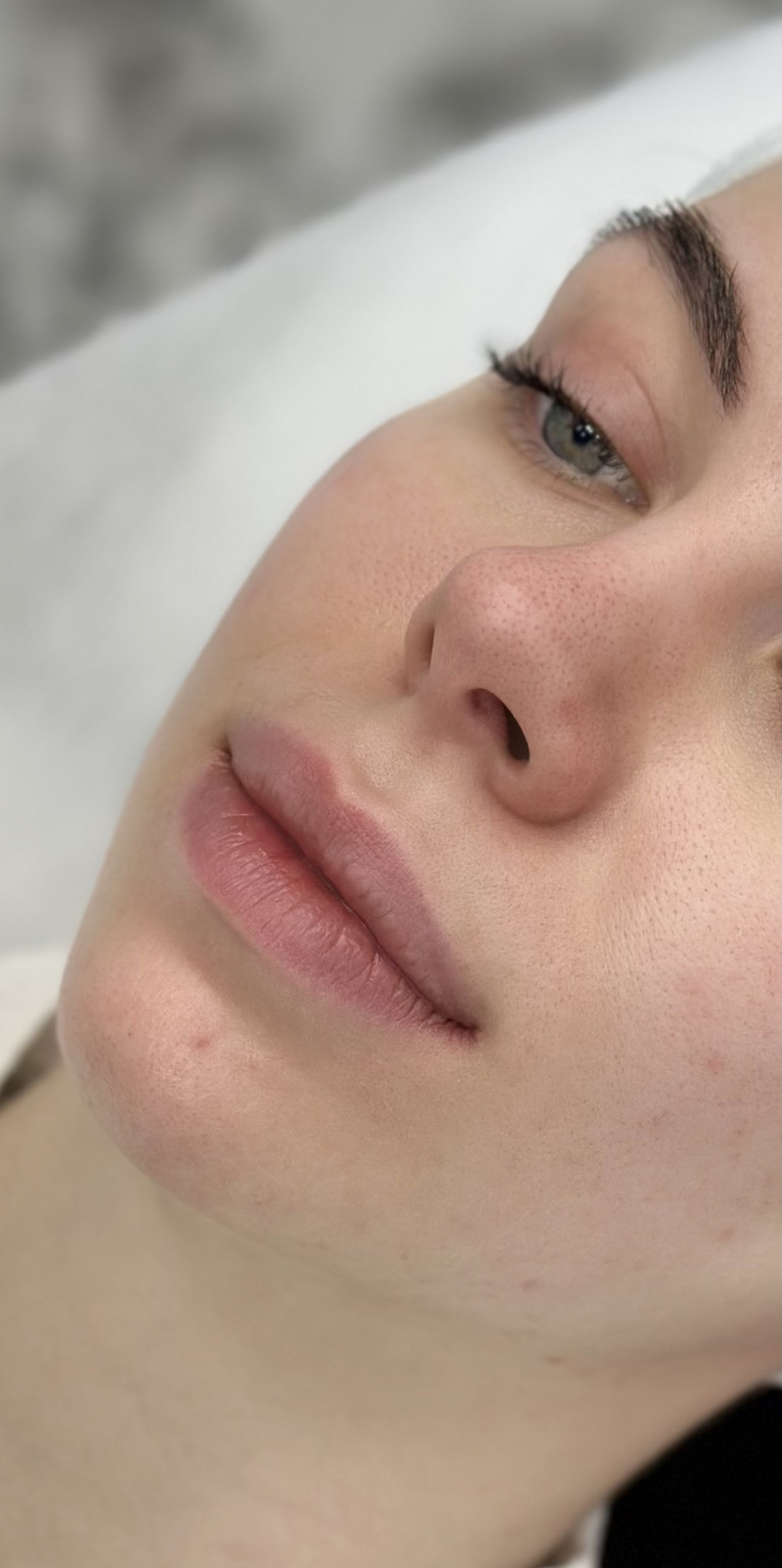 До процедуры Контурная пластика губ